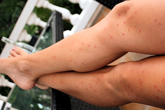 Sand fly bites Sand fly bites